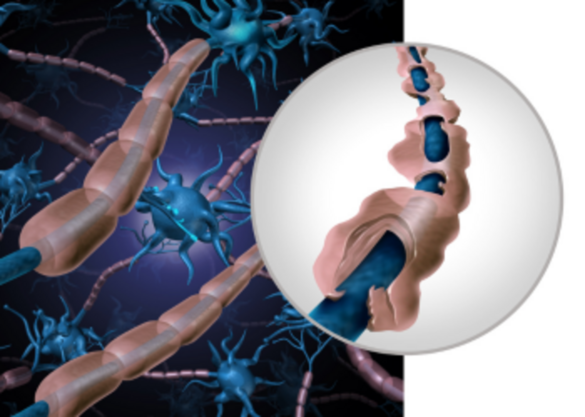 Understanding Multiple Sclerosis (MS) - Dr. Vilas Shingare