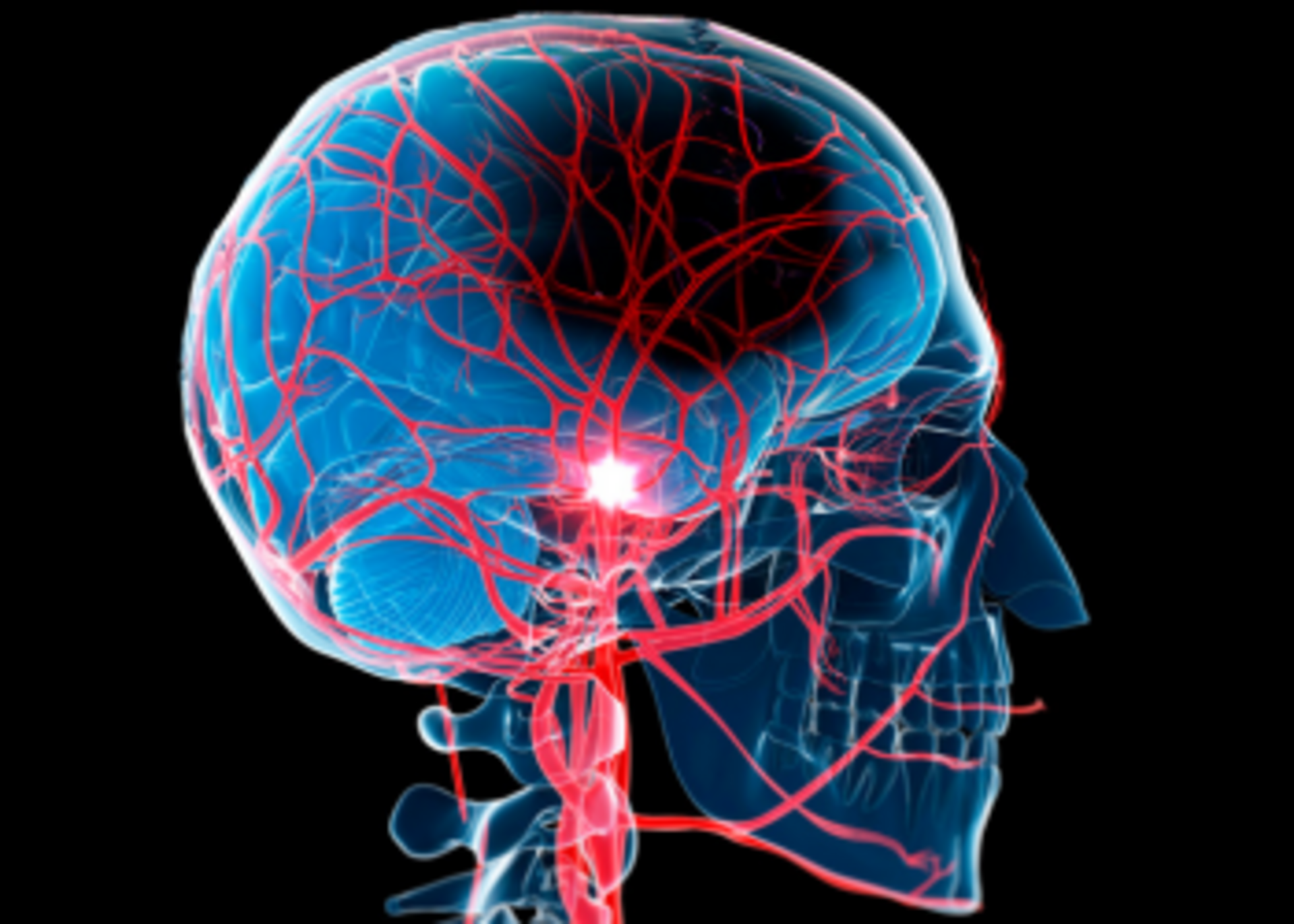 Understanding Strokes - Dr. Vilas Shingare